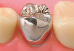 臼歯｜銀のクラウン（保険適応）