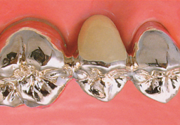 臼歯｜銀のブリッジ（保険適応）